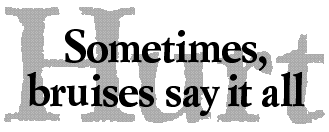 Hurt: Sometimes, bruises say it all
