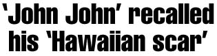 'John John' recalled his 'Hawaiian scar'